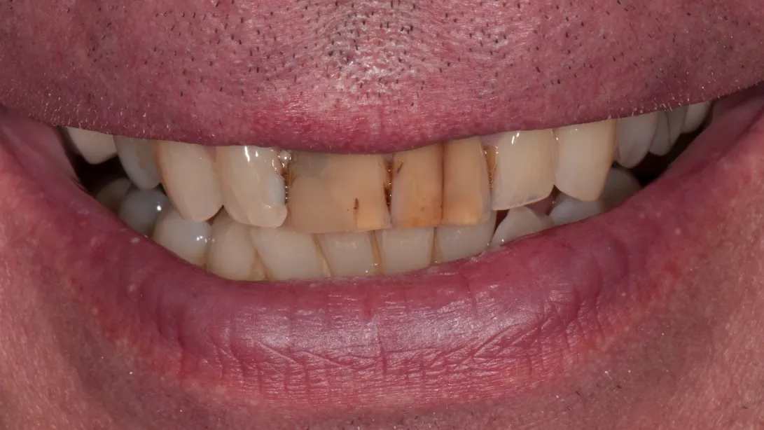 Beeindruckende Zahntransformationen im Vergleich
