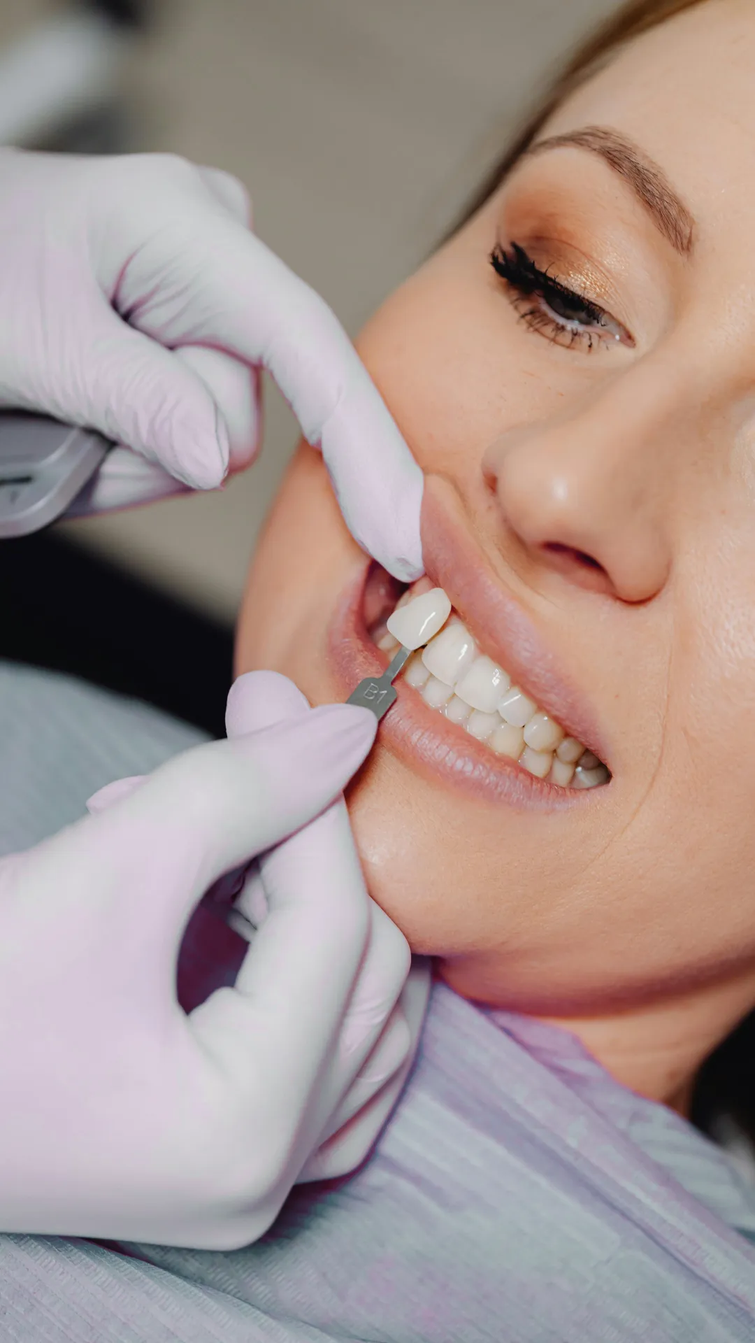 Hochwertige Veneers für ein strahlendes Lächeln